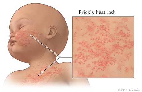Heat rash on baby's chest and cheek, with close-up of rash.