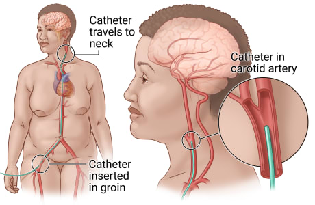 Catheter put into blood vessel at groin and moved up to neck, with detail of catheter in carotid artery in neck.